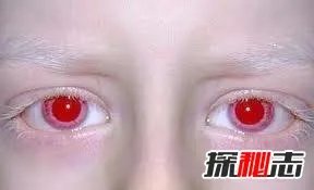 世界上最稀有的眼睛;紫色眼睛（概率只有千万分之一）