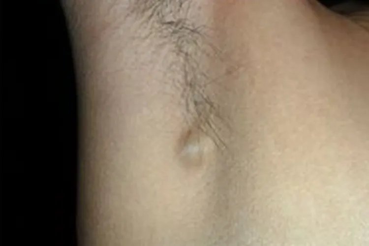 淋巴癌的早期症状图