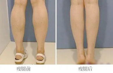 抽脂小腿需要多少钱啊