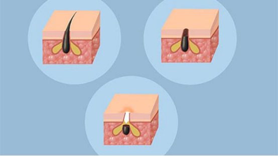 囊肿性痤疮怎么治