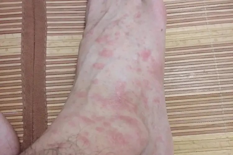 皮肤过敏红肿脚部疙瘩图片