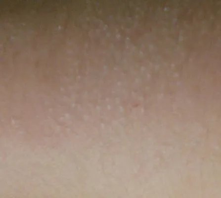 过敏性皮炎的症状