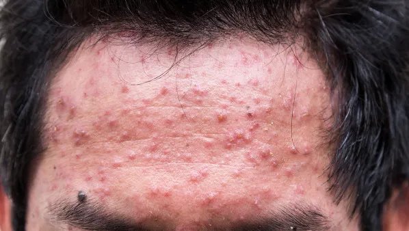 如何去除额头的痘痘