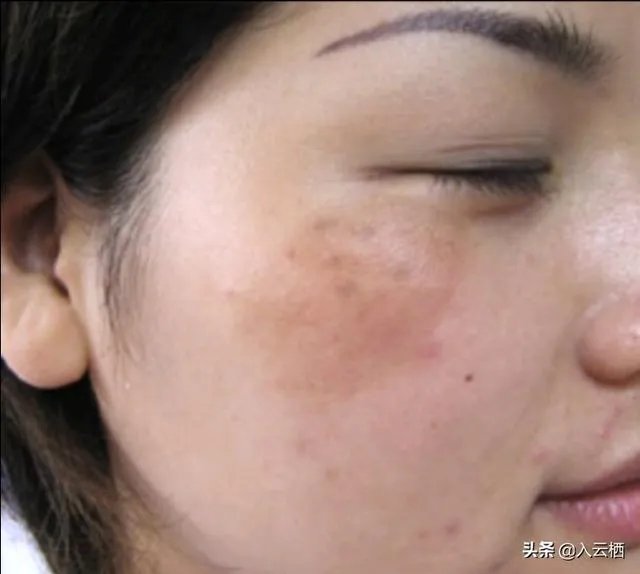 什么叫黄褐斑，雀斑，有什么分别吗？