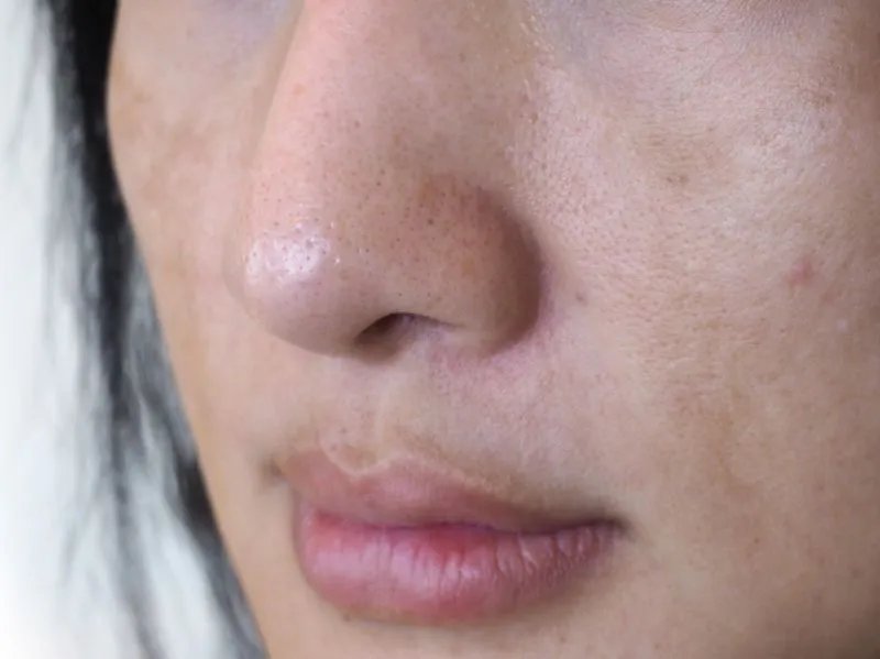 如何有效祛斑？４个最简单有效祛斑的小妙招，祛斑效果好