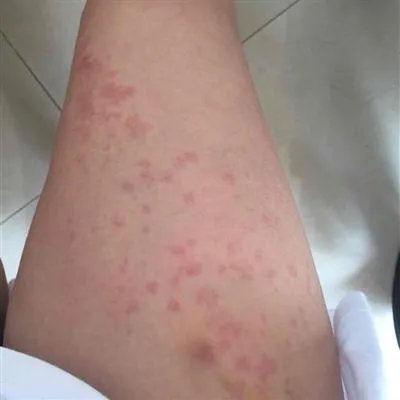 出麻子是什么症状