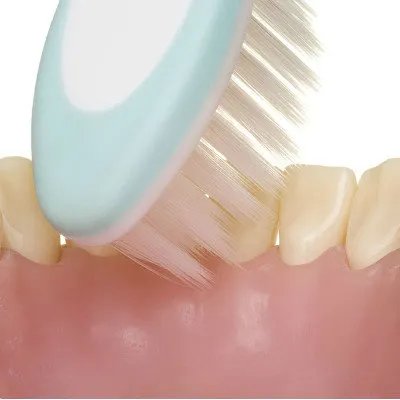 什么是智齿冠周炎？