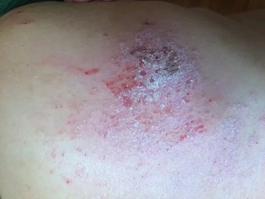 怎样治疗鹅口疮？