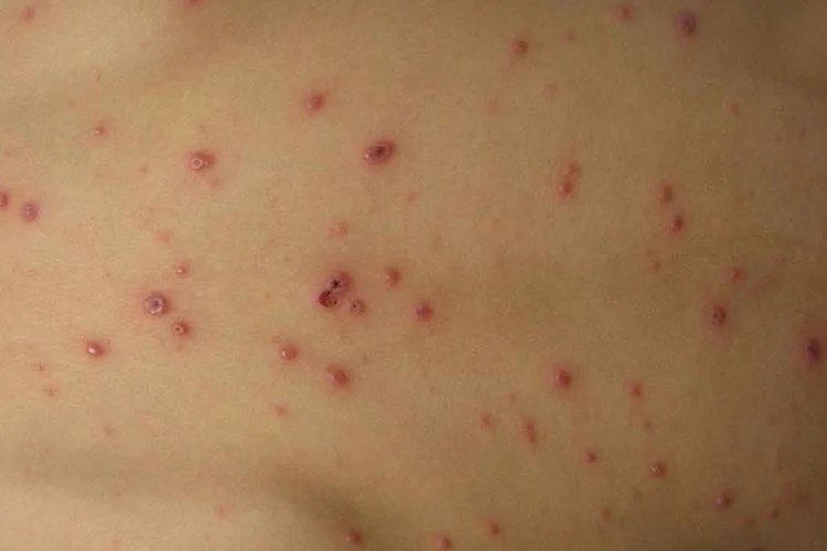 水痘的症状和治疗图片