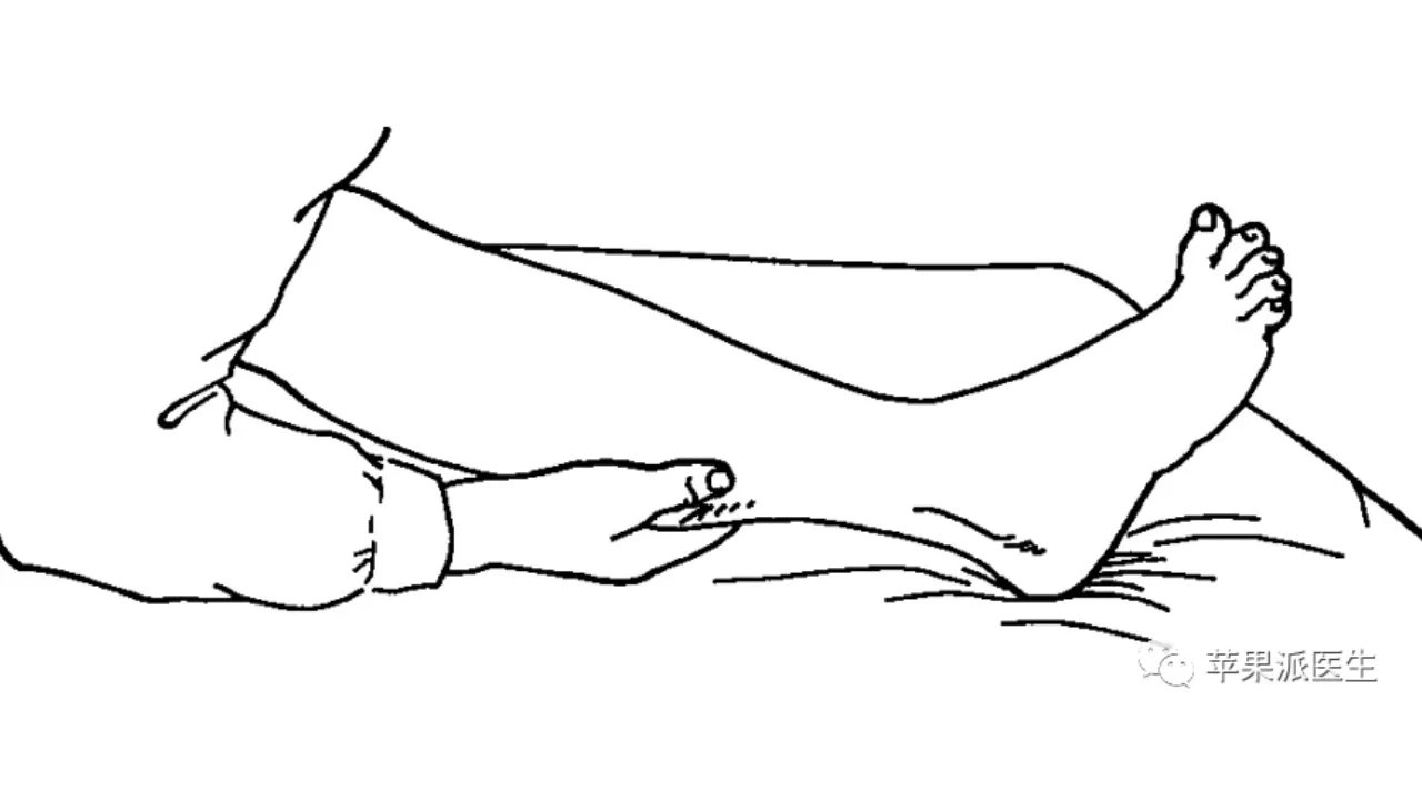 理解Babinski征,划对Babinski征