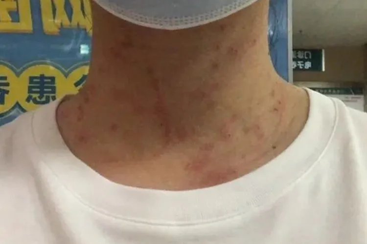 瘊子激光后恢复过程图