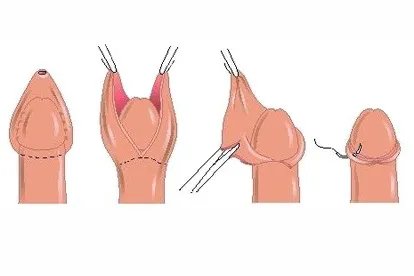小孩子包茎手术过程图片