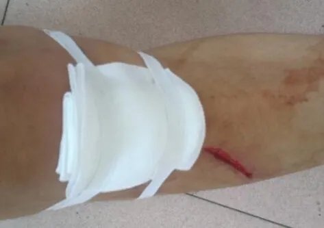 大爷烧伤后先抹盐水后抹大酱，网友调侃其在腌肉，正确做法是怎样的？