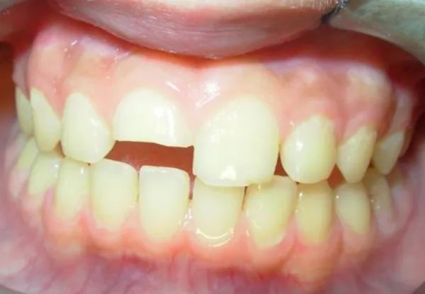 光固化树脂修复是什么？怎样操作的？